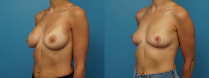 Before & After Breast Lift (Mastopexy) Case 418 Left Oblique View in North Shore, IL