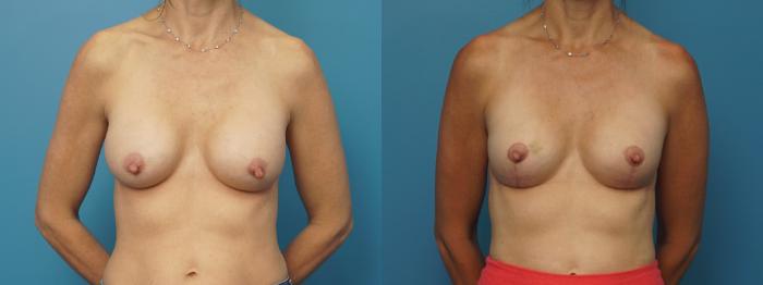 Before & After Breast Augmentation Case 419 Front View in North Shore, IL