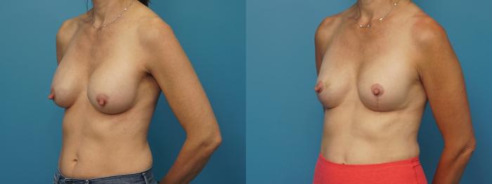 Before & After Breast Augmentation Case 419 Left Oblique View in North Shore, IL
