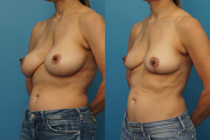 Before & After Breast Lift (Mastopexy) Case 434 Left Oblique View in North Shore, IL