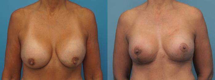 Before & After Breast Augmentation Case 451 Front View in North Shore, IL