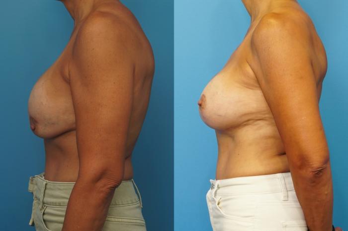 Before & After Breast Lift (Mastopexy) Case 451 Left Side View in North Shore, IL