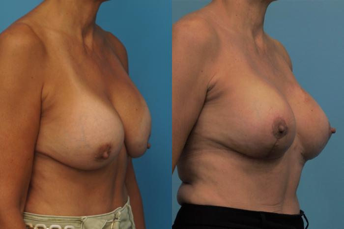 Before & After Breast Augmentation Case 451 Right Oblique View in North Shore, IL