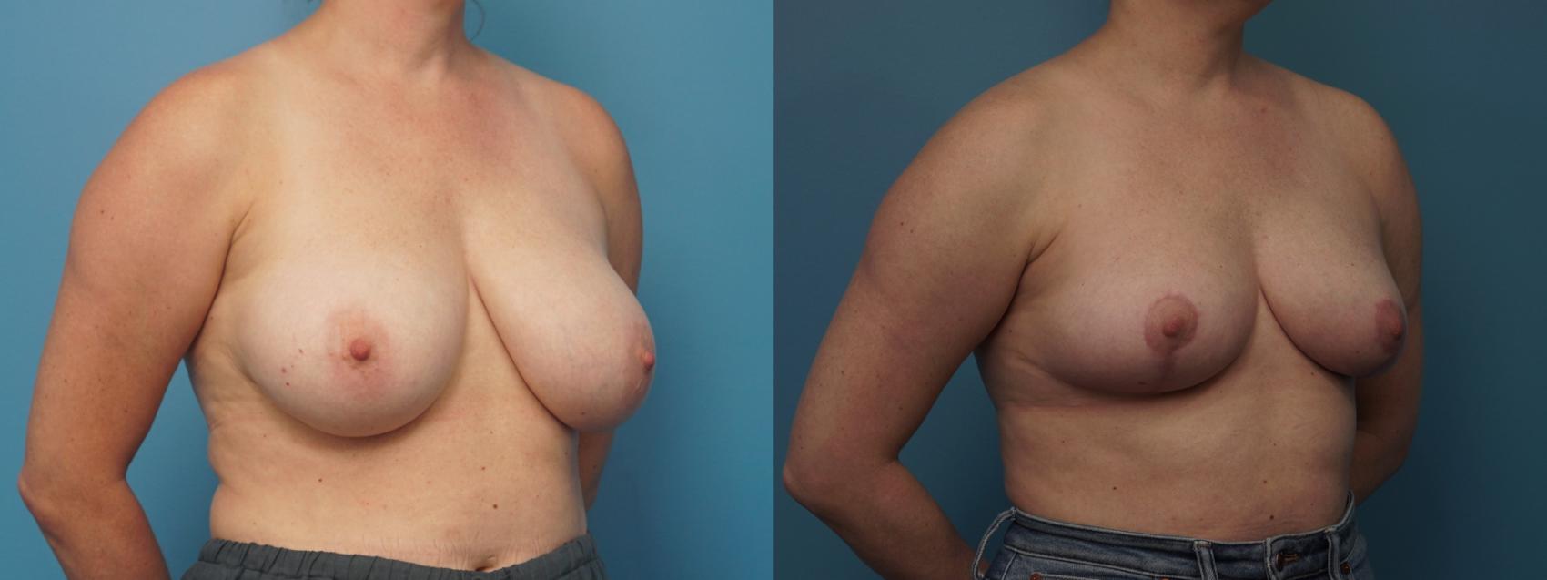 Before & After Breast Lift (Mastopexy) Case 452 Right Oblique View in North Shore, IL