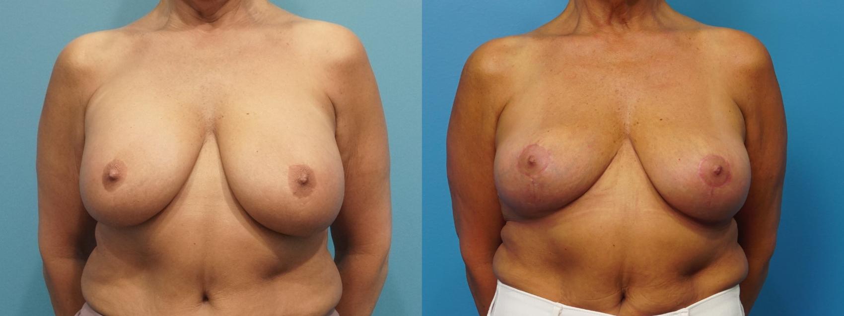 Before & After Revision of Aesthetic Breast Surgery Case 461 Front View in North Shore, IL