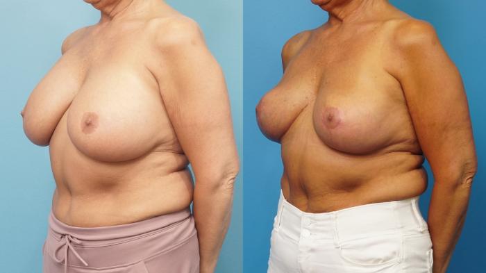 Before & After Breast Lift (Mastopexy) Case 461 Left Oblique View in North Shore, IL