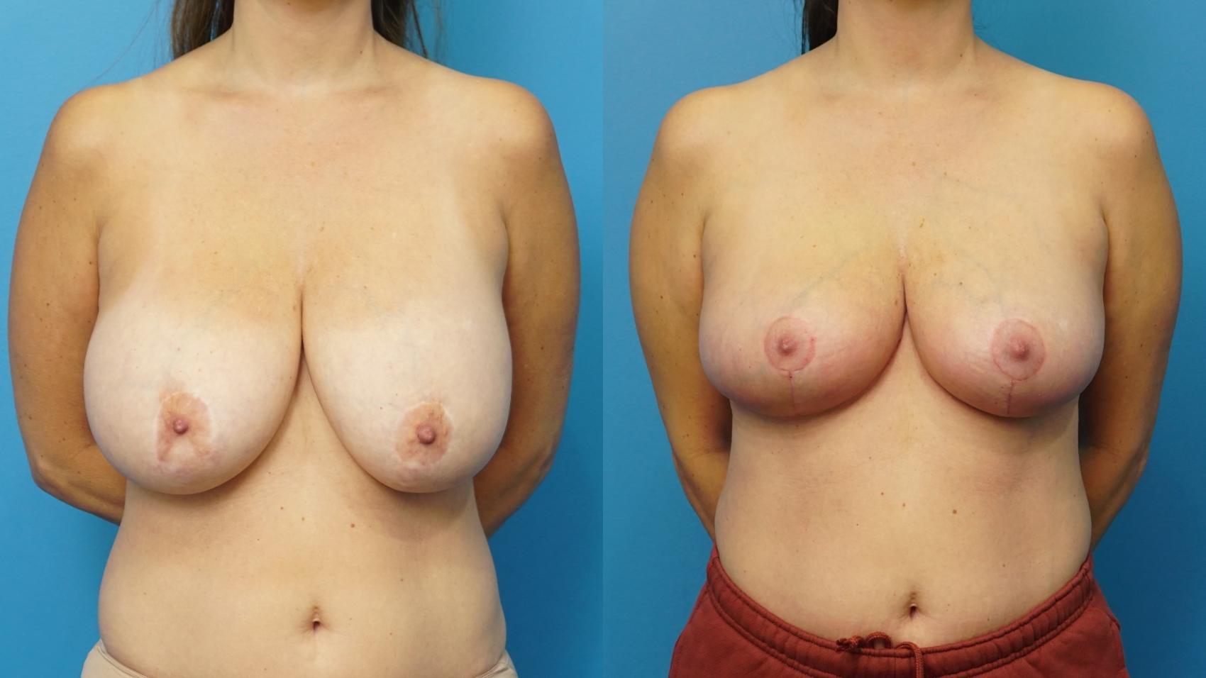 Before & After Breast Implant Removal Case 472 Front View in North Shore, IL