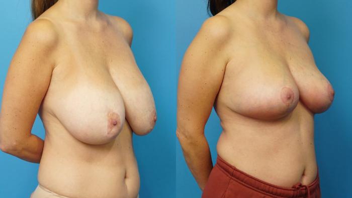 Before & After Breast Implant Removal Case 472 Right Oblique View in North Shore, IL