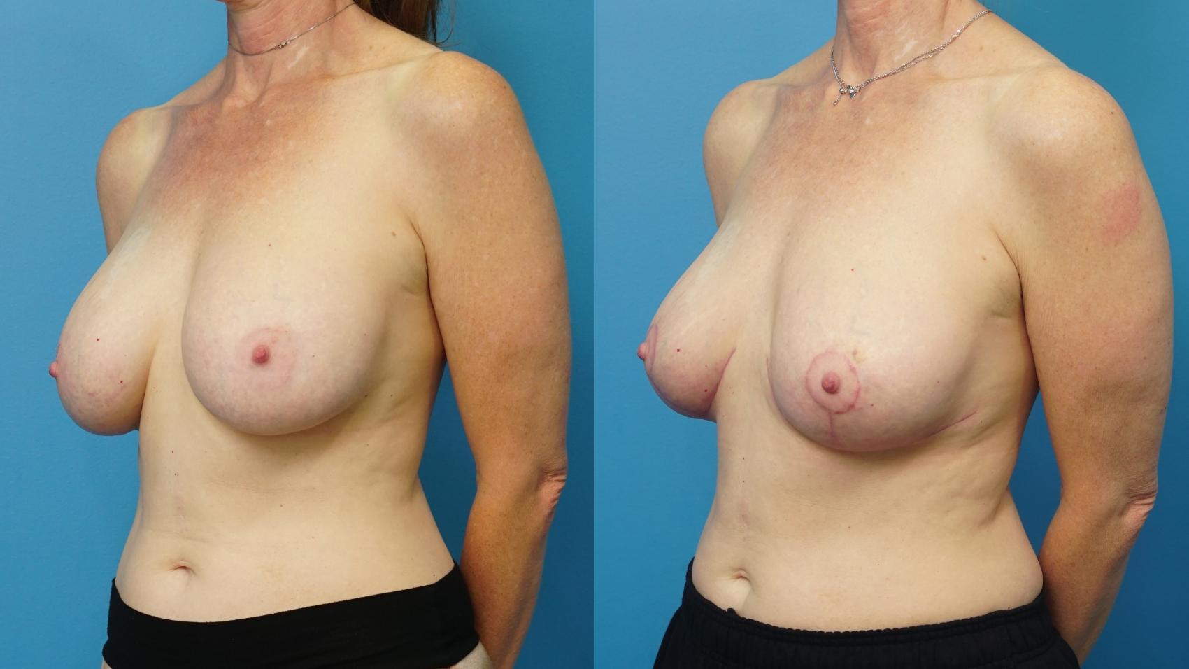 Before & After Breast Lift (Mastopexy) Case 484 Left Oblique View in North Shore, IL