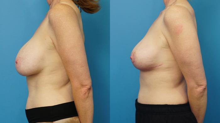 Before & After Breast Lift (Mastopexy) Case 484 Left Side View in North Shore, IL