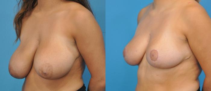 Before & After Breast Lift (Mastopexy) Case 59 View #2 View in Northbrook, IL