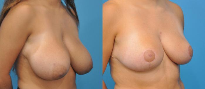 Before & After Breast Lift (Mastopexy) Case 59 View #3 View in Northbrook, IL