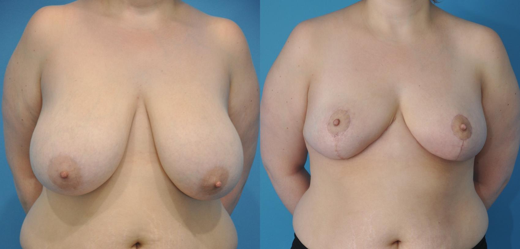 Before & After Breast Lift (Mastopexy) Case 62 View #1 View in Northbrook, IL