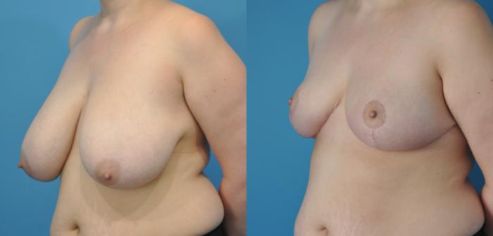 Before & After Breast Lift (Mastopexy) Case 62 View #2 View in North Shore, IL