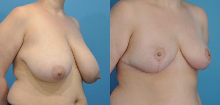 Before & After Breast Lift (Mastopexy) Case 62 View #3 View in North Shore, IL