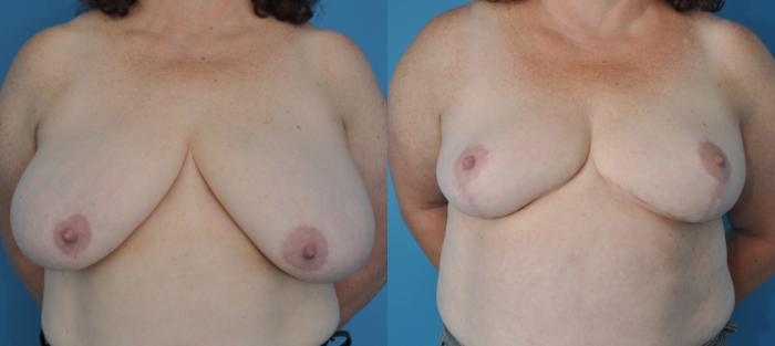 Before & After Breast Lift (Mastopexy) Case 70 View #1 View in North Shore, IL