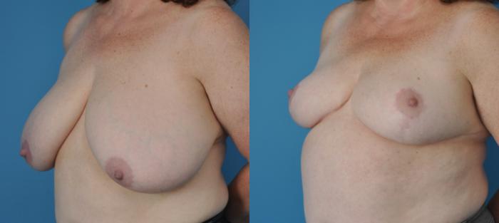 Before & After Breast Lift (Mastopexy) Case 70 View #2 View in North Shore, IL