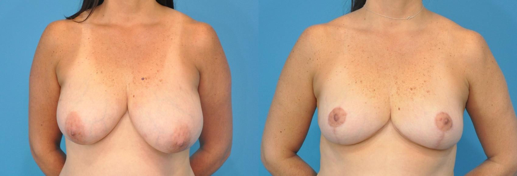 Before & After Breast Lift (Mastopexy) Case 89 View #1 View in Northbrook, IL