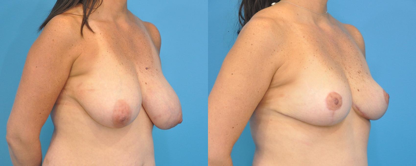 Before & After Breast Lift (Mastopexy) Case 89 View #2 View in Northbrook, IL