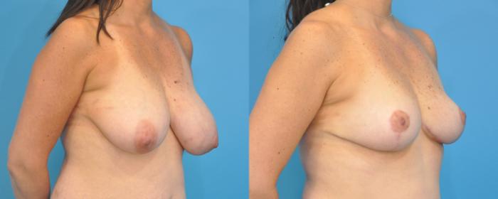 Before & After Breast Lift (Mastopexy) Case 89 View #2 View in North Shore, IL