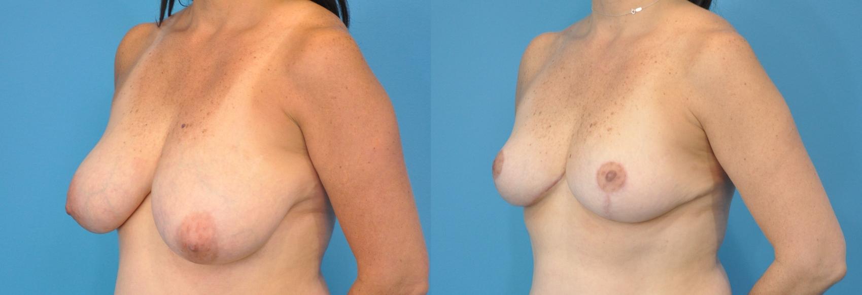 Before & After Breast Lift (Mastopexy) Case 89 View #3 View in Northbrook, IL