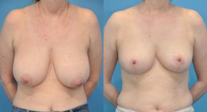 Before & After Breast Lift (Mastopexy) Case 91 View #1 View in North Shore, IL