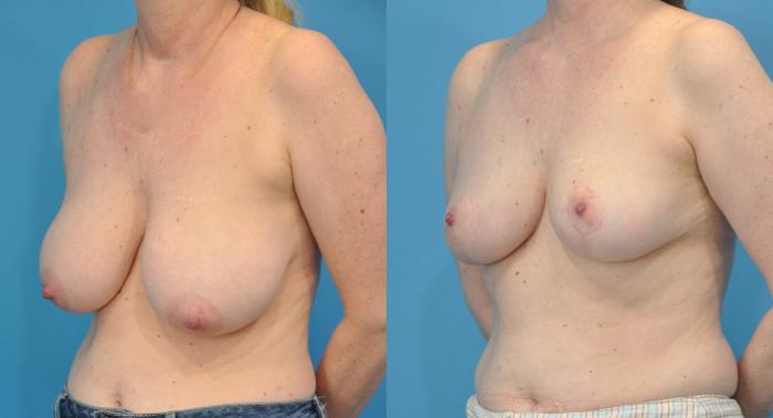 Before & After Breast Lift (Mastopexy) Case 91 View #2 View in North Shore, IL