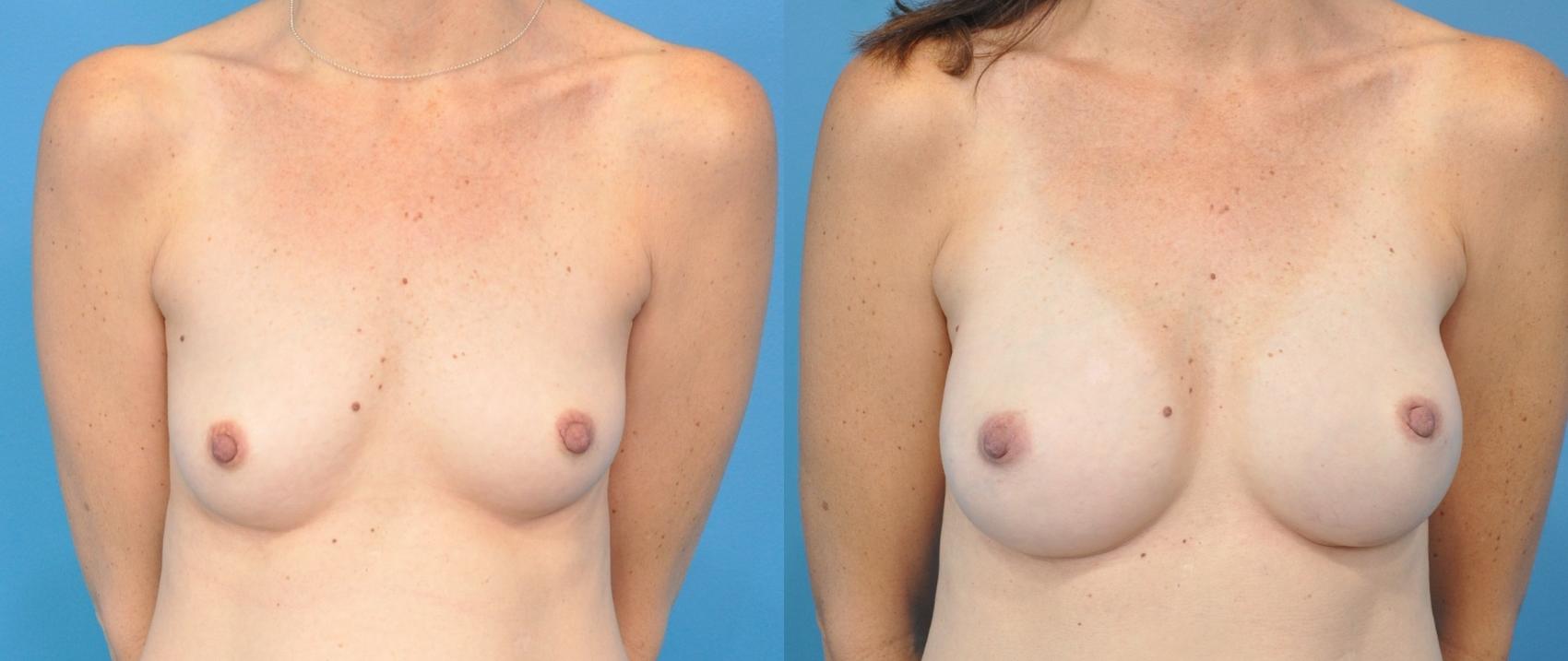 Before & After Breast Reconstruction Case 138 View #1 View in Northbrook, IL