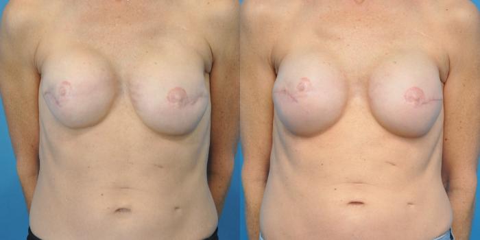 Before & After Breast Reconstruction Case 151 View #1 View in Northbrook, IL