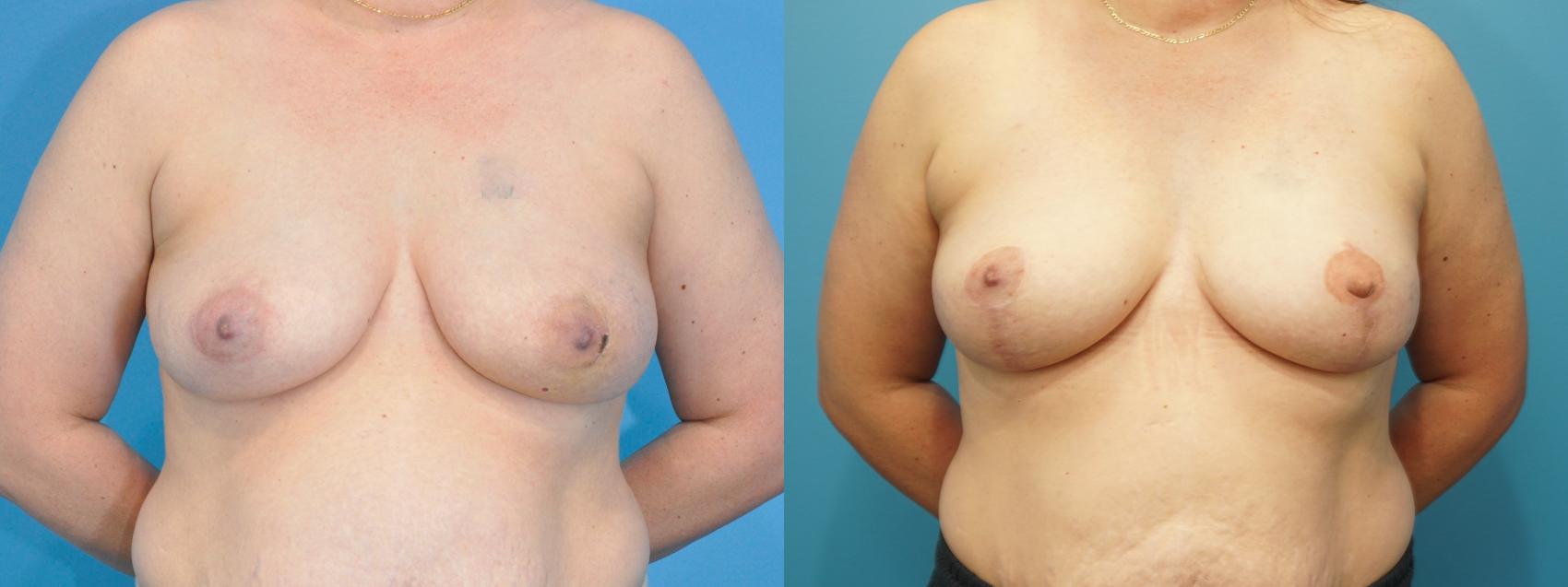 Before & After Breast Reconstruction Case 262 Front View in North Shore, IL