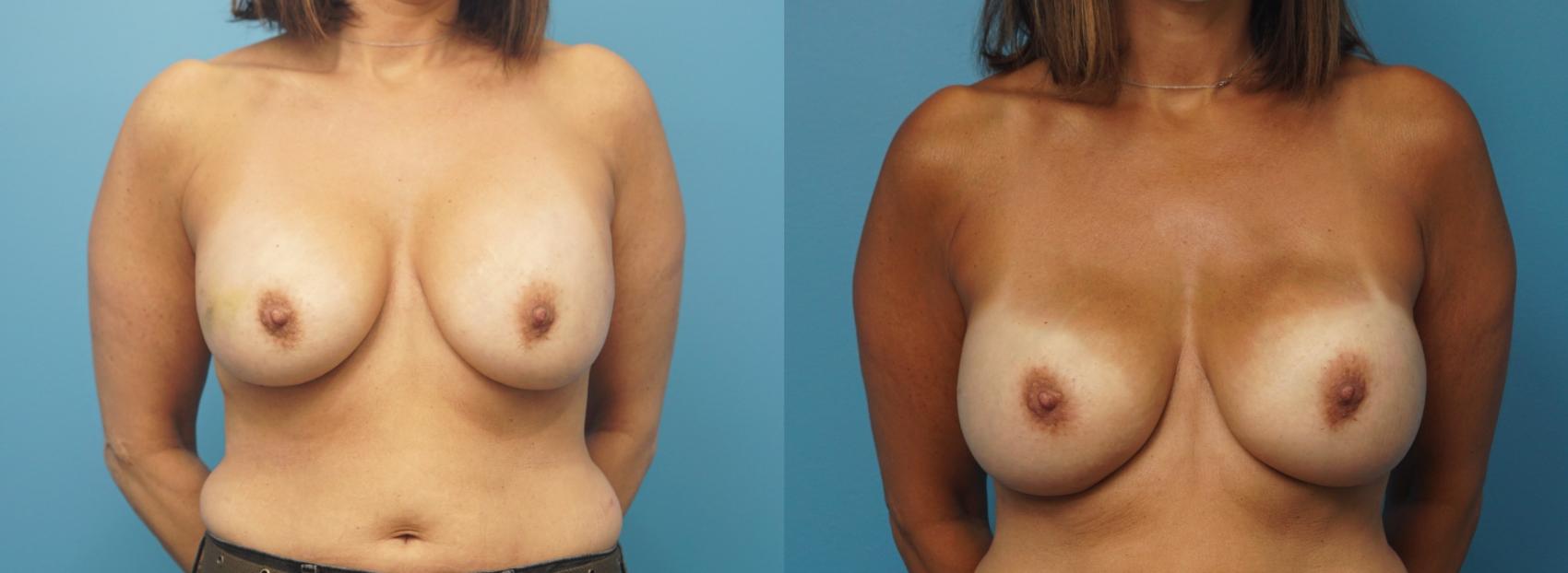 Before & After Breast Reconstruction Case 330 Front View in Northbrook, IL
