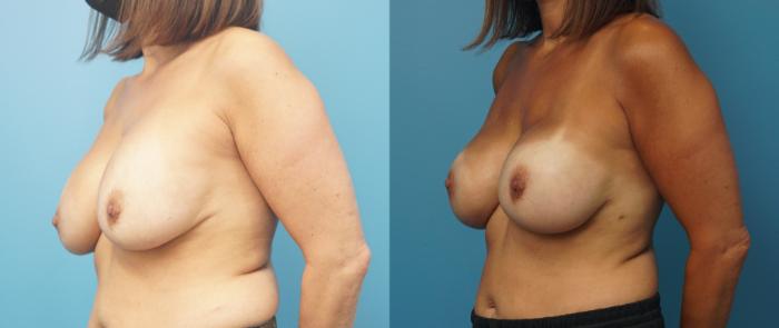 Before & After Breast Reconstruction Case 330 Left Oblique View in North Shore, IL
