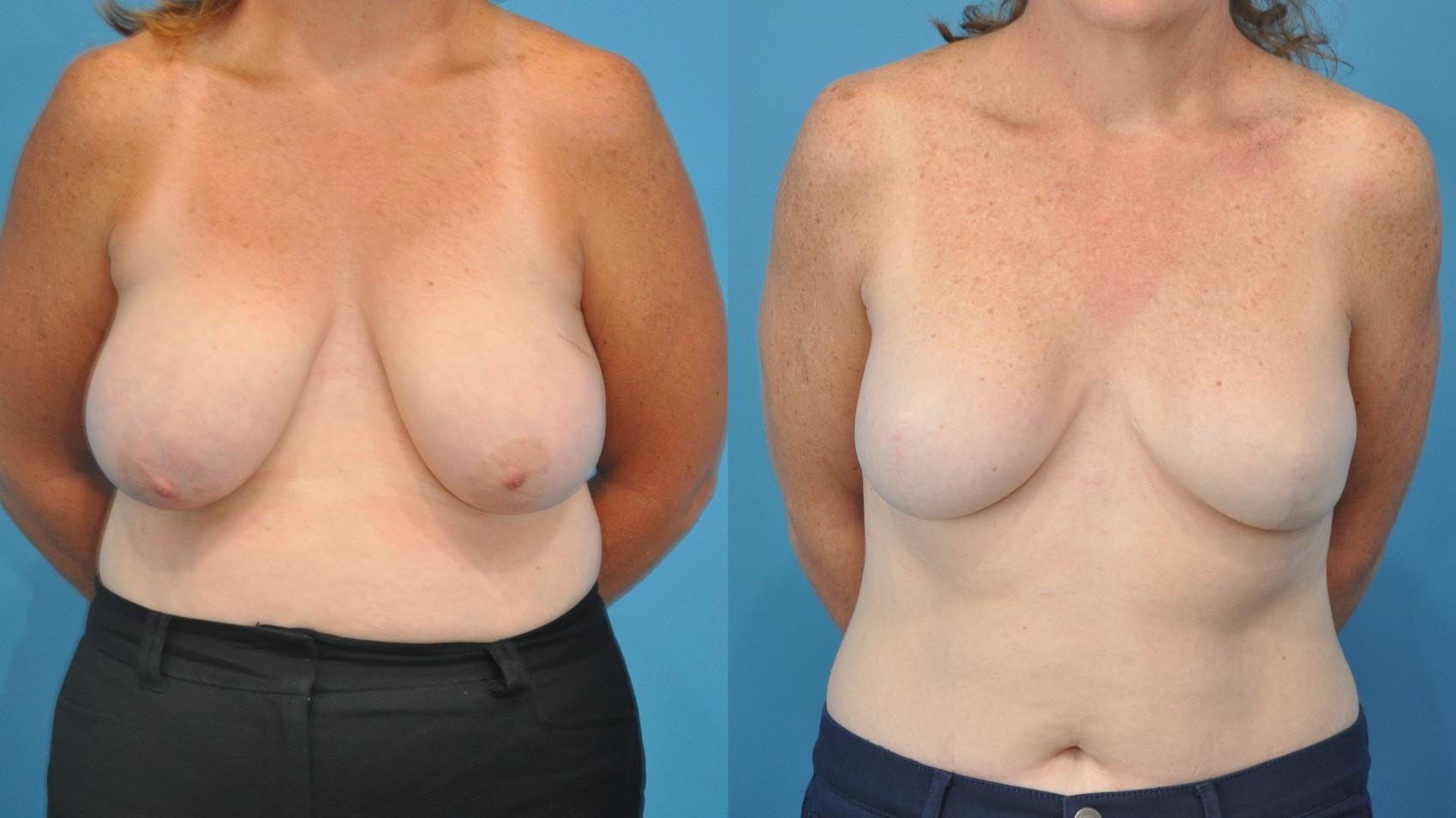 Before & After Breast Reconstruction Case 335 Front View in Northbrook, IL