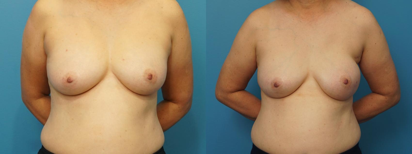Before & After Breast Reconstruction Case 380 Front View in North Shore, IL