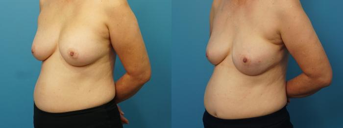 Before & After Breast Reconstruction Case 380 Left Oblique View in North Shore, IL