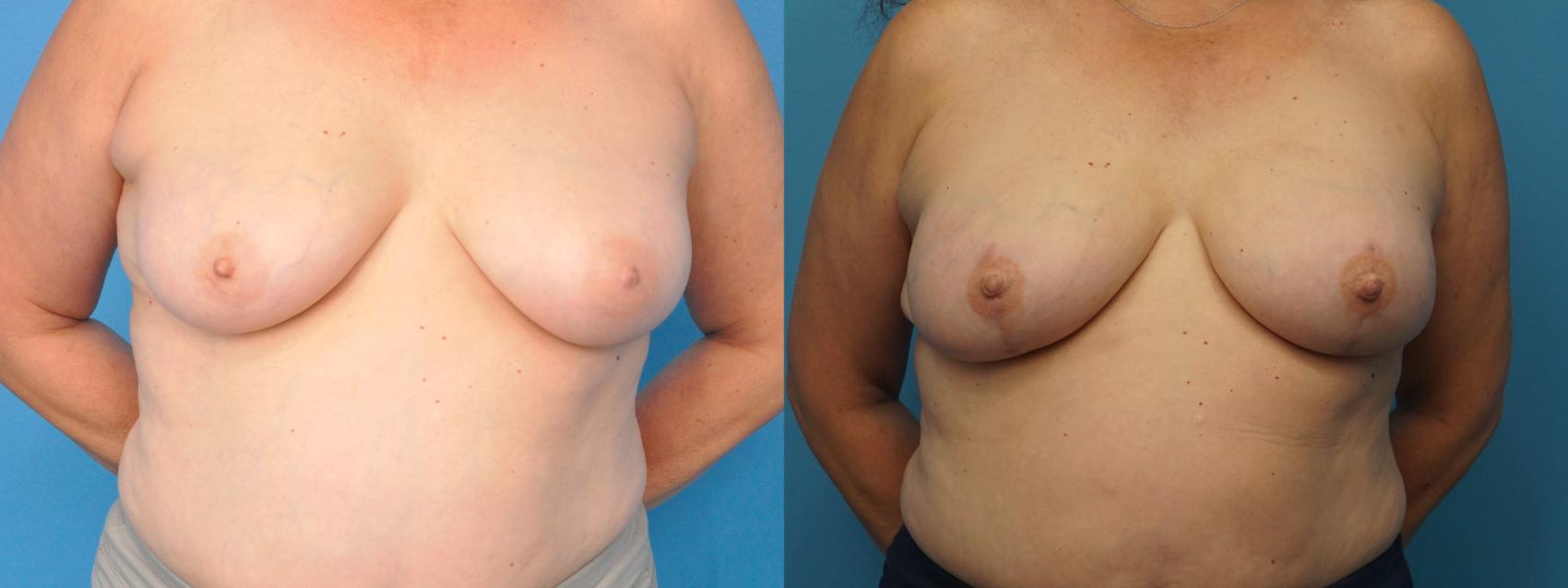 Before & After Breast Reconstruction Case 381 Front View in North Shore, IL