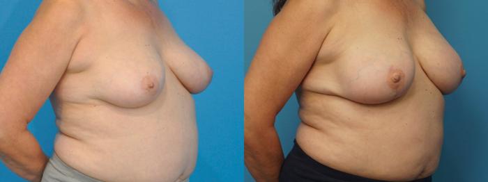 Before & After Breast Reconstruction Case 381 Right Oblique View in North Shore, IL