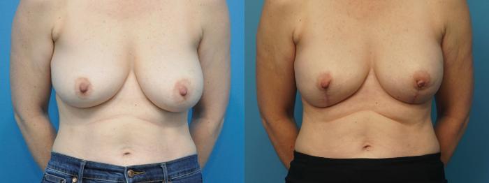 Before & After Breast Lift (Mastopexy) Case 388 Front View in North Shore, IL