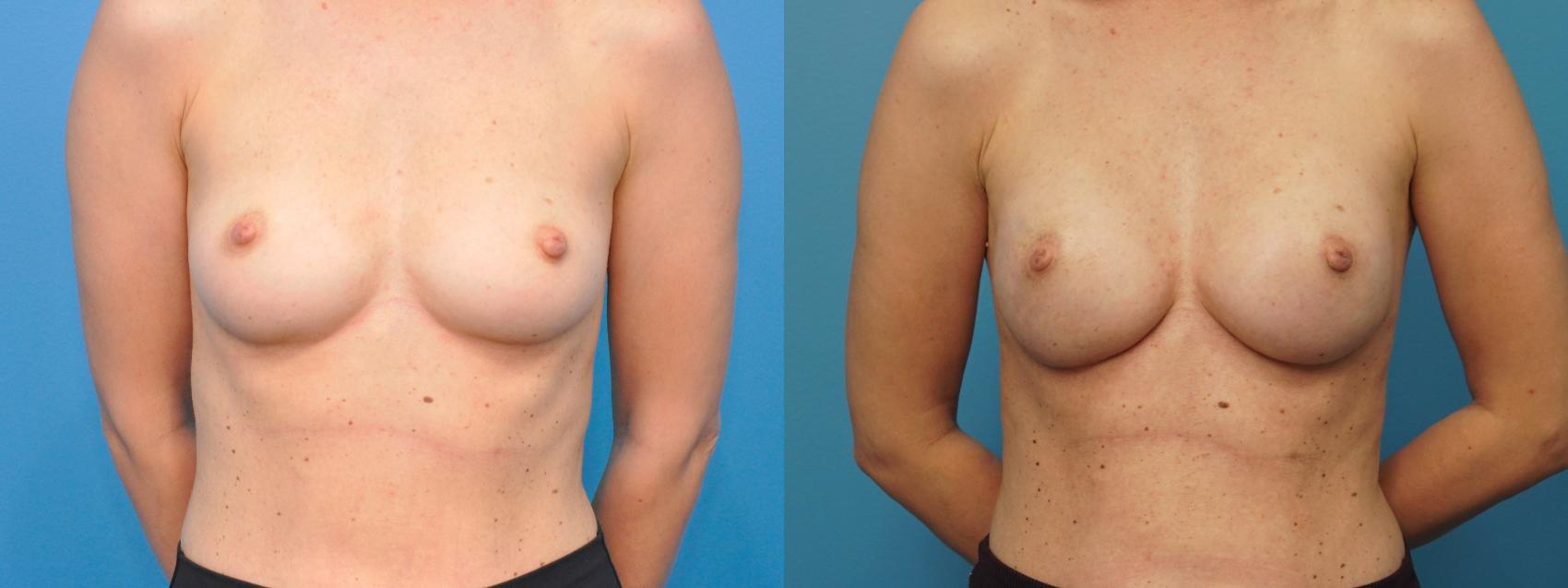 Before & After Breast Reconstruction Case 389 Front View in North Shore, IL