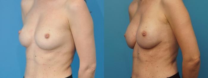 Before & After Breast Reconstruction Case 389 Left Oblique View in North Shore, IL