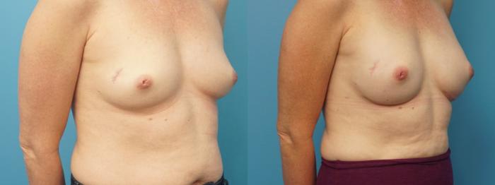 Before & After Breast Reconstruction Case 392 Right Oblique View in North Shore, IL