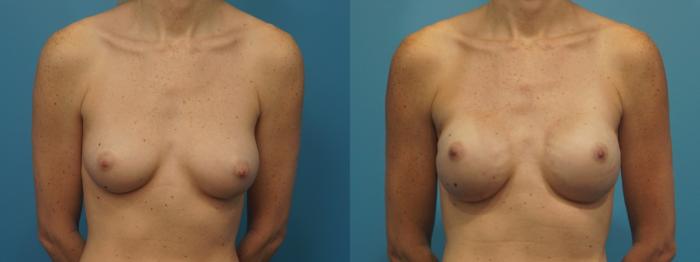 Before & After Breast Reconstruction with Implants Case 427 Front View in North Shore, IL