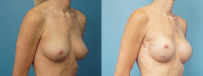Before & After Breast Reconstruction with Implants Case 427 Right Oblique View in North Shore, IL