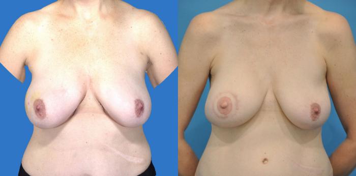 Before & After Breast Reconstruction with DIEP/TRAM Flaps Case 14 View #1 View in North Shore, IL