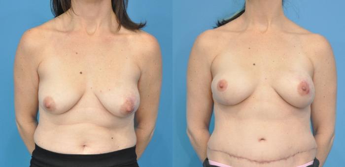 Before & After Breast Reconstruction with DIEP/TRAM Flaps Case 166 View #1 View in North Shore, IL