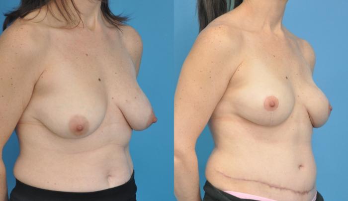 Before & After Breast Reconstruction with DIEP/TRAM Flaps Case 166 View #2 View in North Shore, IL
