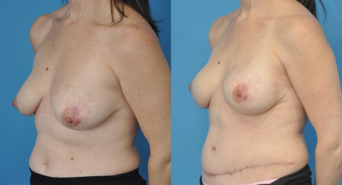 Before & After Breast Reconstruction with DIEP/TRAM Flaps Case 166 View #3 View in North Shore, IL