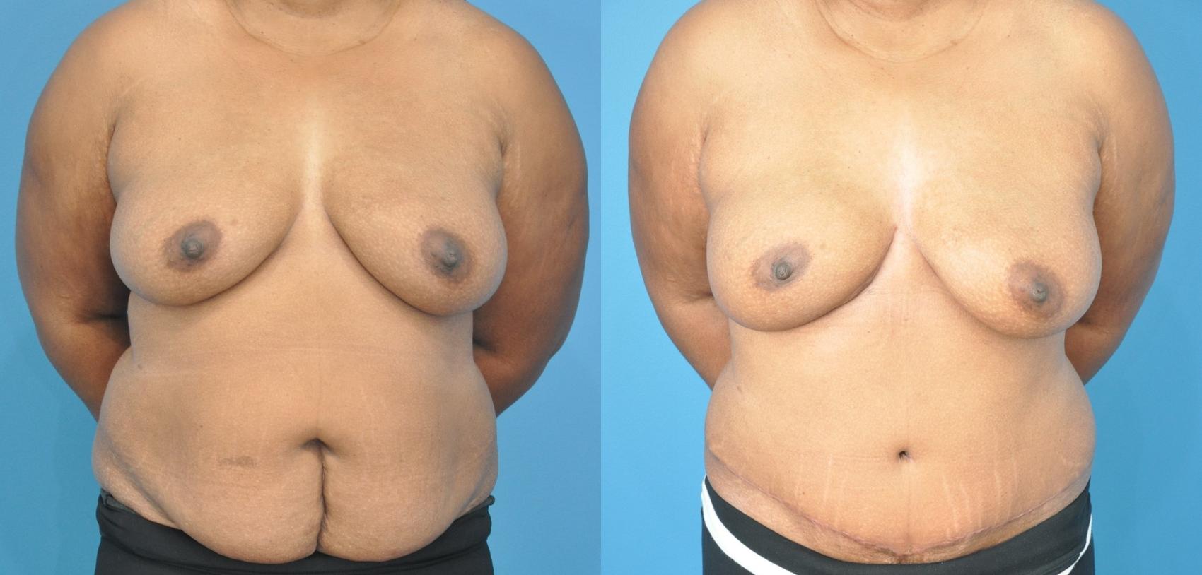 Before & After Breast Reconstruction with DIEP/TRAM Flaps Case 177 View #1 View in North Shore, IL