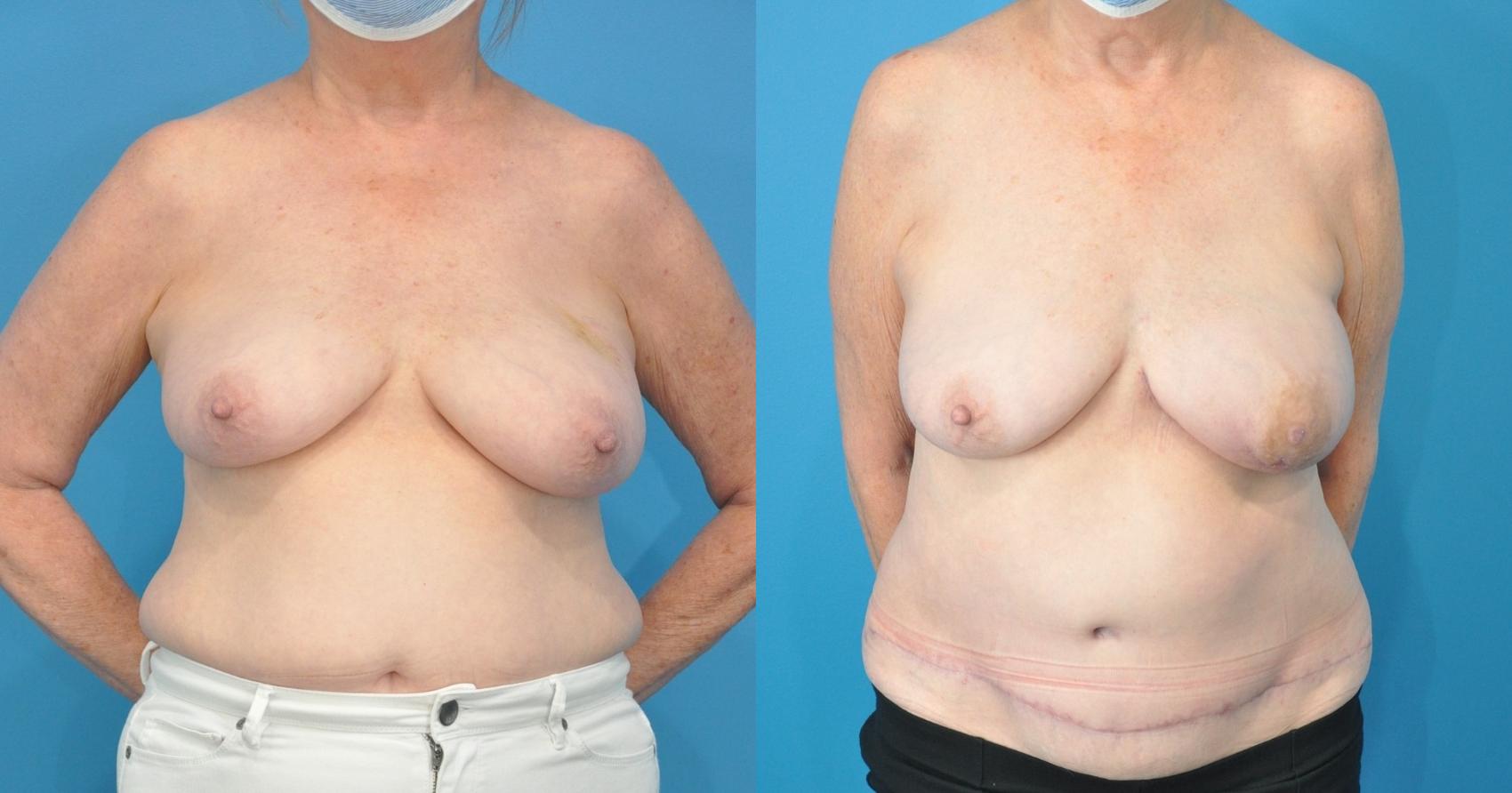Before & After Breast Reconstruction with DIEP/TRAM Flaps Case 194 View #1 View in North Shore, IL