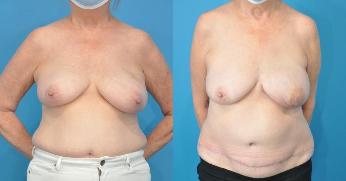 Before & After Breast Reconstruction with DIEP/TRAM Flaps Case 194 View #1 View in Northbrook, IL